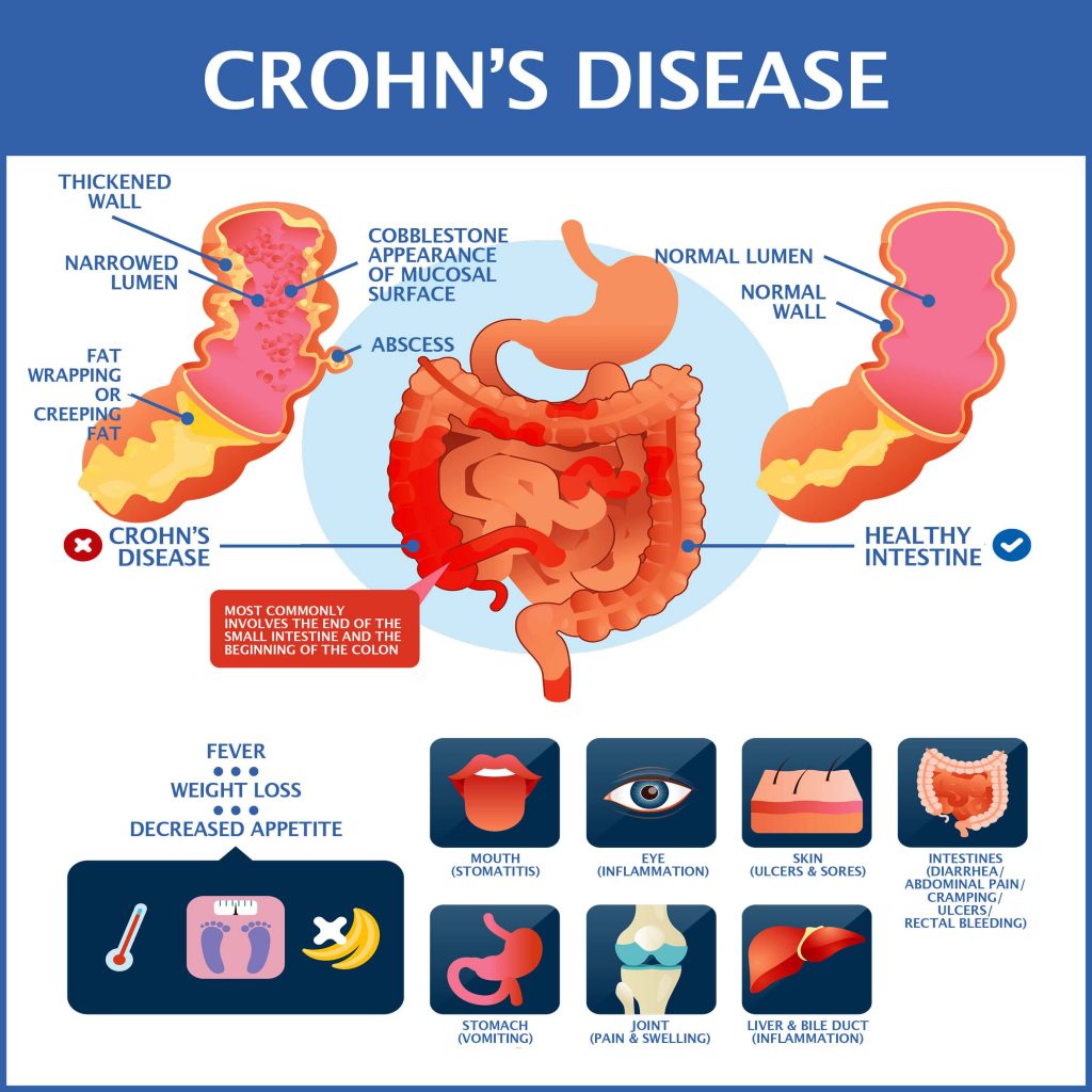 Crohn's Disease: Lucy Dare's Inspiring Journey image 0e2e5b45 192e 4617 8d14 6e659c7a1688.png