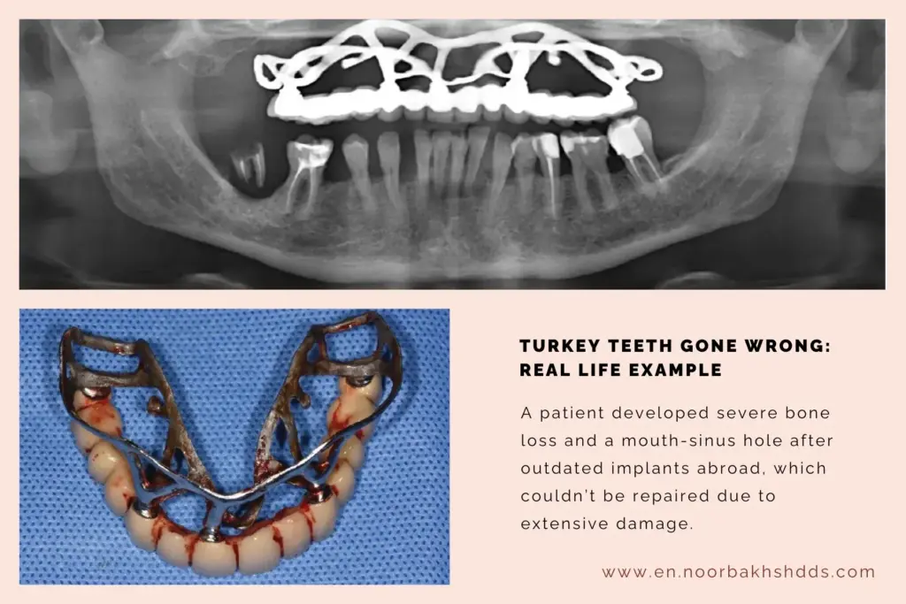 Turkey Teeth Complications: A Cautionary Tale from Telford image 4a69363b 9352 42cf 8912 c53fc15643d1.webp