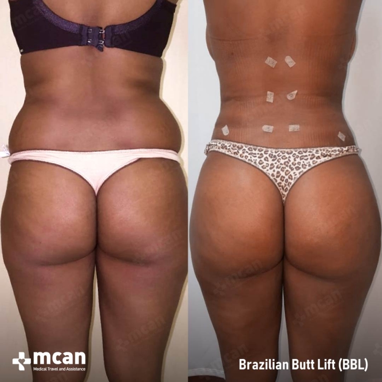 brazilian butt lift before after 5 768x768.jpg